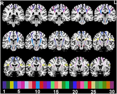 The Severity of Sensorimotor Tracts Degeneration May Predict Motor Performance in Chronic Stroke Patients, While Brain Structural Network Dysfunction May Not